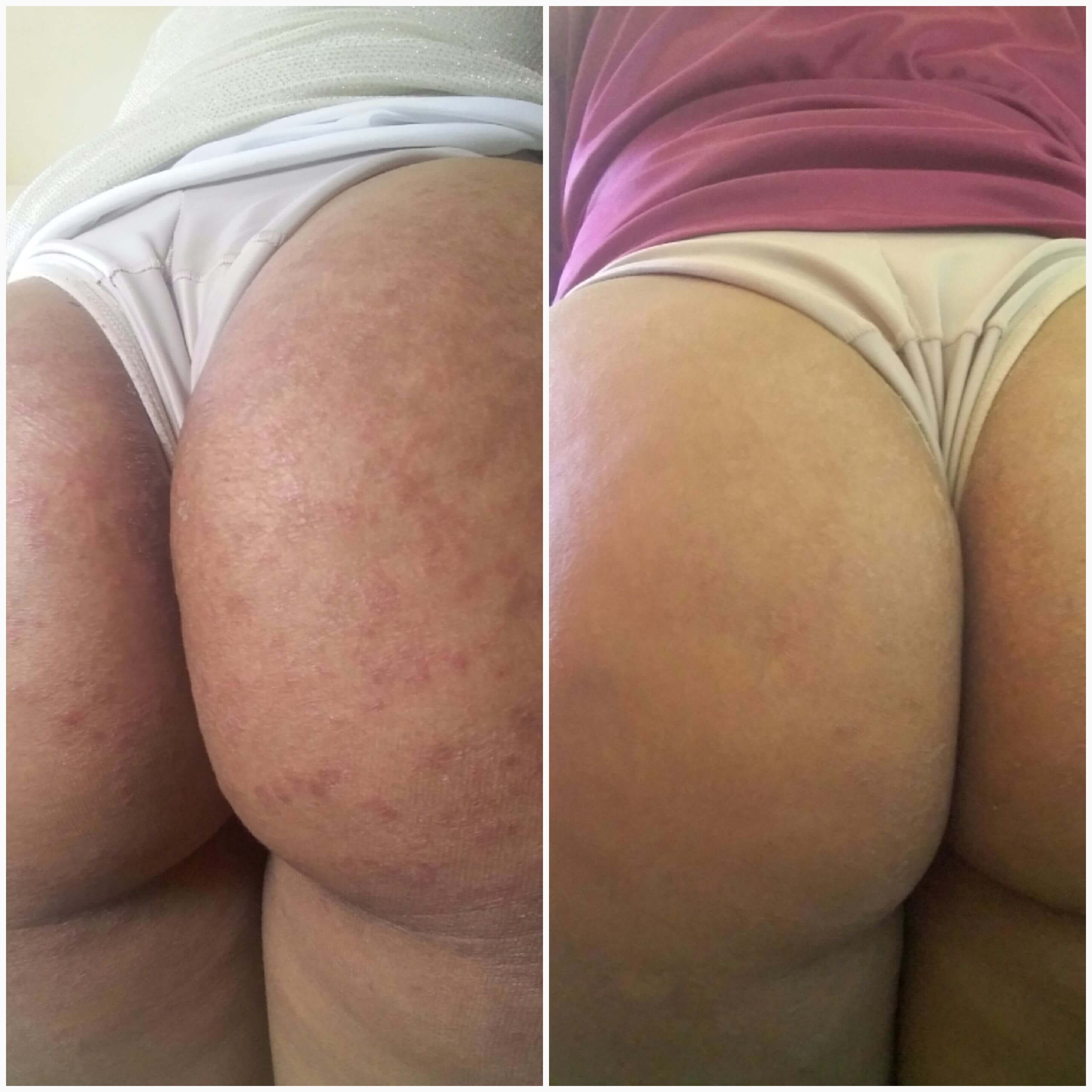 Resultado Tend Skin 2018 — foliculite eliminada com tratamento contínuo
